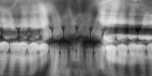 An X-Ray image of wisdom teeth